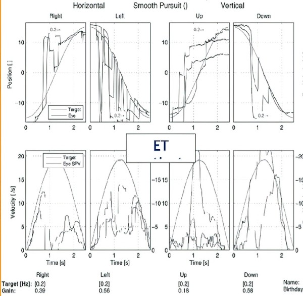 Периферический вестибулярный синдром			     
        Периферический вестибулярный синдром