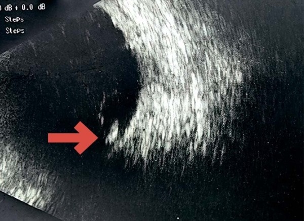 
        Внутриглазная миграция металлического инородного тела			    