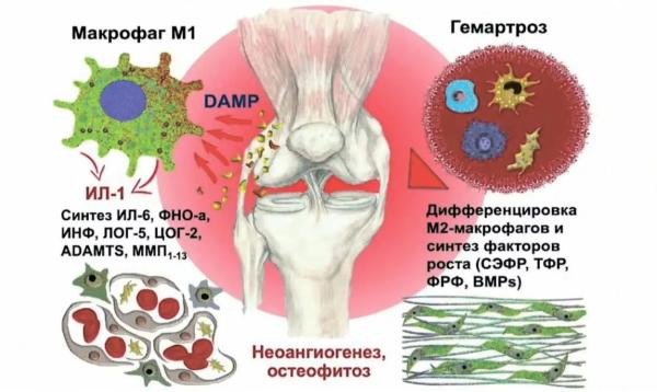 
        Посттравматический остеоартрит: патогенез, клинические особенности и подходы к лечению			    
