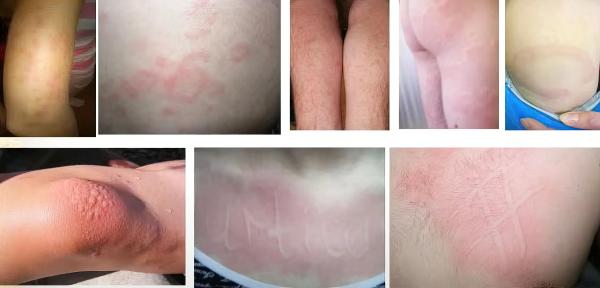 
        Зудящие дерматозы у детей: клиническая симптоматика и тактика лечения			    