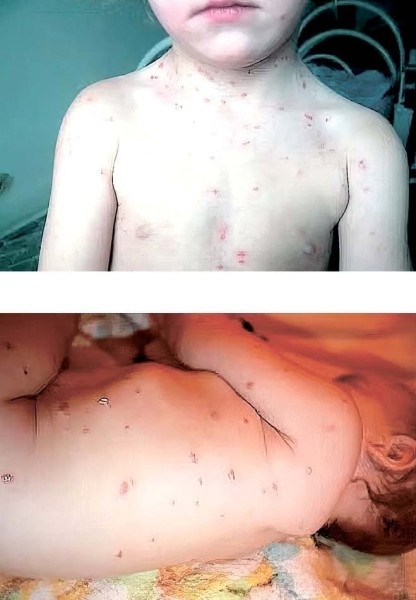 
        Зудящие дерматозы у детей: клиническая симптоматика и тактика лечения			    