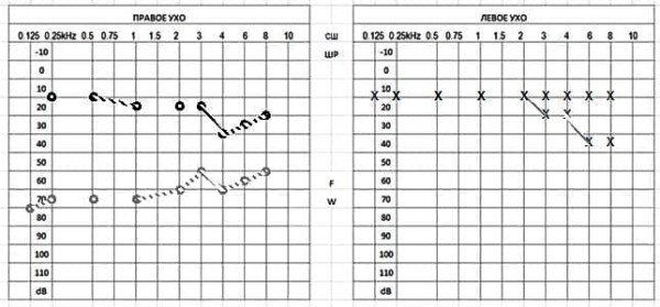 Клинический случай семейного отосклероза                     
        Клинический случай семейного отосклероза