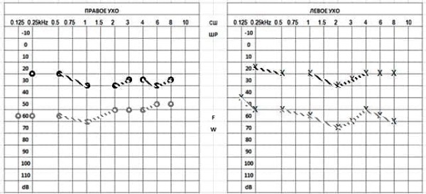 Клинический случай семейного отосклероза                     
        Клинический случай семейного отосклероза