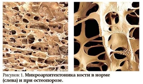 Остеопороз в клинической практике                     
        Остеопороз в клинической практике
