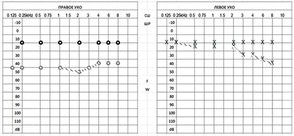 Клинический случай семейного отосклероза                     
        Клинический случай семейного отосклероза