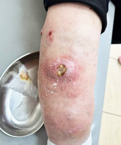 
        Лучевая терапия как вариант лечения нерезектабельных местно-распространенных опухолей кожи                    