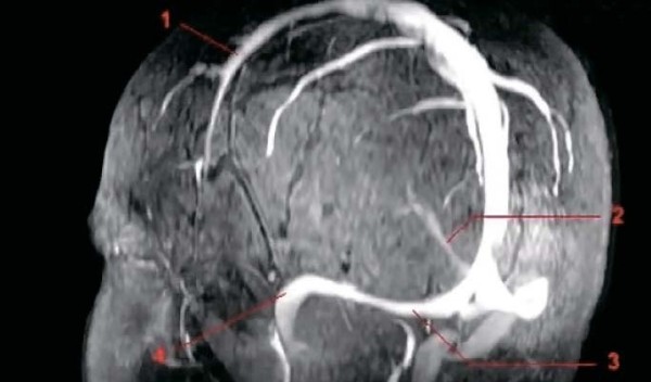 Венозная энцефалопатия: постановка диагноза, подходы к лечению                     
        Венозная энцефалопатия: постановка диагноза, подходы к лечению