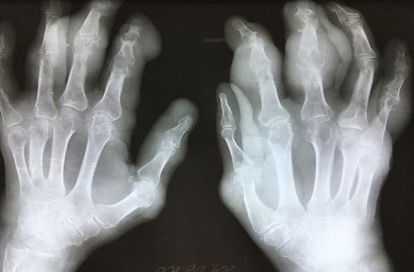 В капкане подагры + аудио                
        
         
        В капкане подагры + аудио