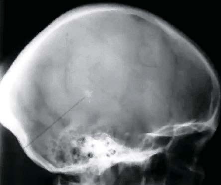 Венозная энцефалопатия: постановка диагноза, подходы к лечению                     
        Венозная энцефалопатия: постановка диагноза, подходы к лечению