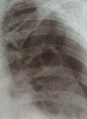 О терапии деструктивных форм туберкулеза легких                      
        О терапии деструктивных форм туберкулеза легких