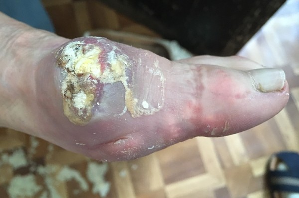 В капкане подагры + аудио                
        
         
        В капкане подагры + аудио