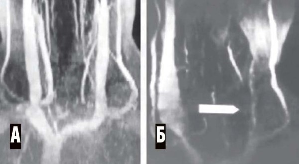 Венозная энцефалопатия: постановка диагноза, подходы к лечению                     
        Венозная энцефалопатия: постановка диагноза, подходы к лечению