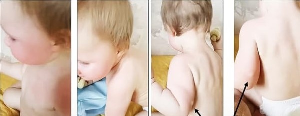 
        Синдром активации тучных клеток. Почему не всегда возможно добиться контроля течения аллергических заболеваний?                    