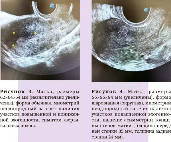 Примеры ошибок и гипердиагностика аденомиоза при проведении УЗ-исследований                     
        Примеры ошибок и гипердиагностика аденомиоза при проведении УЗ-исследований