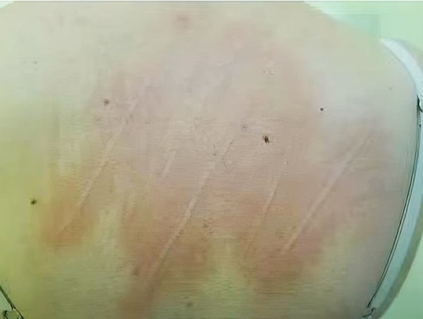 
        Синдром активации тучных клеток. Почему не всегда возможно добиться контроля течения аллергических заболеваний?                    