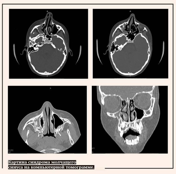 
        Если синус «уснул»… Ателектаз верхнечелюстной пазухи                    