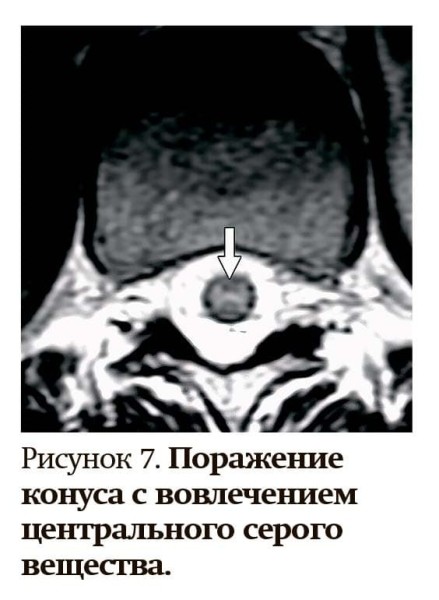 
        Заболевания спектра оптиконейромиелита                    