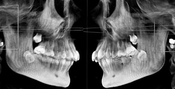
        Надо ли удалять «восьмерки»? Как принять обоснованное решение                    