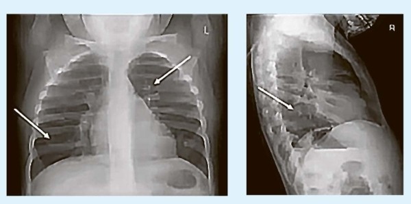 Кашель у детей: особенности дифференциальной диагностики                     
        Кашель у детей: особенности дифференциальной диагностики