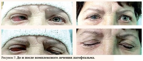 Особенности лечения  пациентов с различными видами лагофтальма                     
        Особенности лечения  пациентов с различными видами лагофтальма