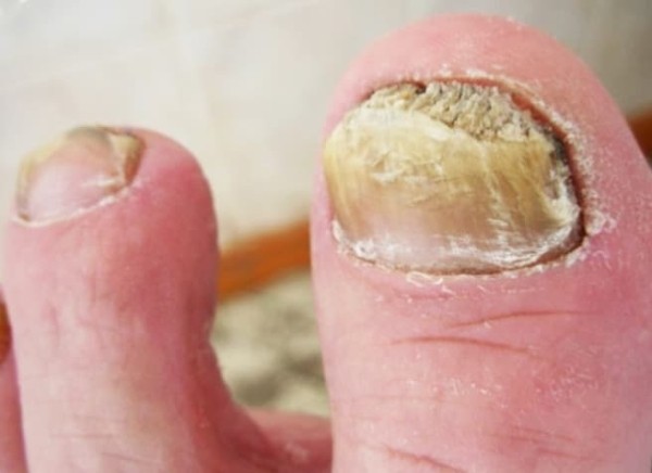 Ногти: клинико-диагностическая значимость в практике дерматолога + аудио                
        
         
        Ногти: клинико-диагностическая значимость в практике дерматолога + аудио