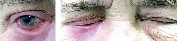 Особенности лечения  пациентов с различными видами лагофтальма                     
        Особенности лечения  пациентов с различными видами лагофтальма