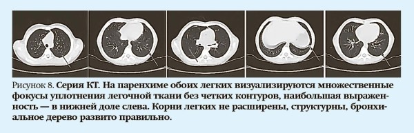 
        Кашель у детей: особенности дифференциальной диагностики                    