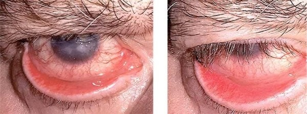 Особенности лечения  пациентов с различными видами лагофтальма                     
        Особенности лечения  пациентов с различными видами лагофтальма