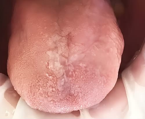 ГЭРБ снимает «маску»: стоматологические проявления, под которыми прячется заболевание + аудио                
        
         
        ГЭРБ снимает «маску»: стоматологические проявления, под которыми прячется заболевание + аудио