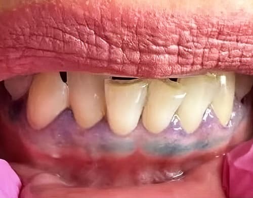 ГЭРБ снимает «маску»: стоматологические проявления, под которыми прячется заболевание + аудио                
        
         
        ГЭРБ снимает «маску»: стоматологические проявления, под которыми прячется заболевание + аудио