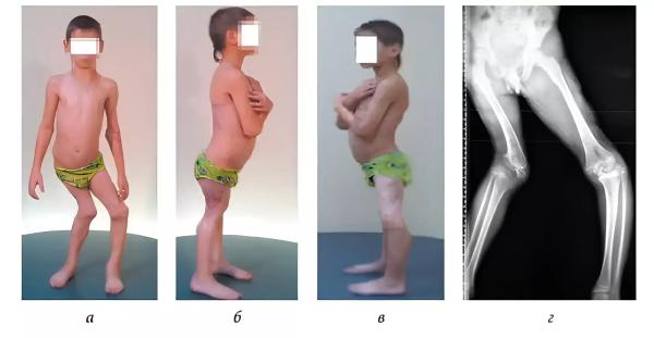 
        Юрий Лобзин: «Каждый пятый пациент с менингококковой инфекцией госпитализируется только на вторые сутки или позже»                    