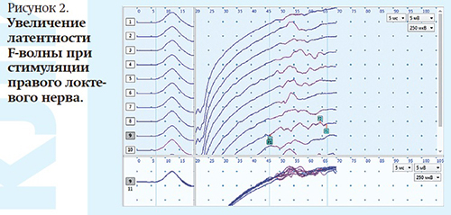 Хроническая воспалительная  демиелинизирующая полиневропатия с острым началом у беременной + аудио                
        
         
        Хроническая воспалительная  демиелинизирующая полиневропатия с острым началом у беременной + аудио