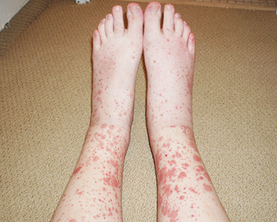 Дерматологические осложнения COVID-19 и тактика ведения пациентов с заболеваниями кожи                     
        Дерматологические осложнения COVID-19 и тактика ведения пациентов с заболеваниями кожи