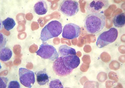 Острый миелоидный лейкоз у детей                     
        Острый миелоидный лейкоз у детей