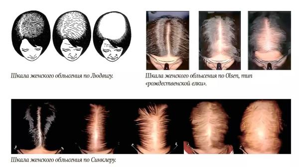 Алопеция у женщин: поиск возможных причин  и подходы к лечению                      
        Алопеция у женщин: поиск возможных причин  и подходы к лечению