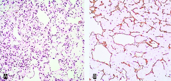 
        Опухоль в сердце: сложности диагностики и хирургии                    