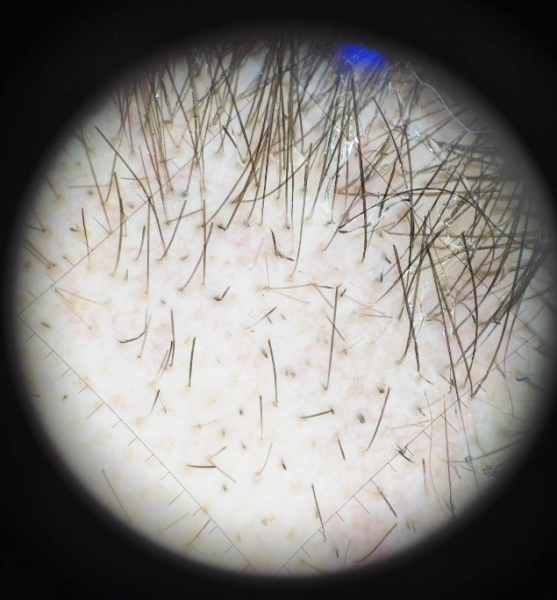 COVID-19 и выпадение волос                     
        COVID-19 и выпадение волос