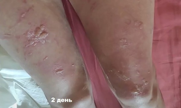 
        Фотодерматозы: фототоксические ожоги, аллергические реакции и солнечная крапивница                    