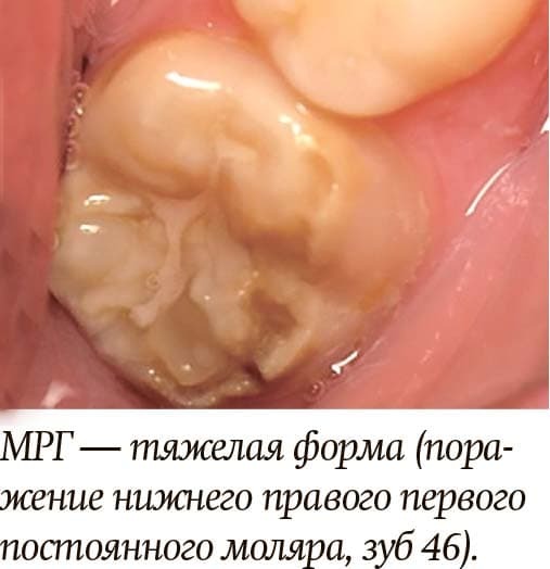 
        Диагностика и лечение молярно-резцовой гипоминерализации у детей + аудио                
        
        