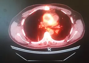 ПЭТ в диагностике воспалительных изменений после кардиохирургических вмешательств		 
			ПЭТ в диагностике воспалительных изменений после кардиохирургических вмешательств