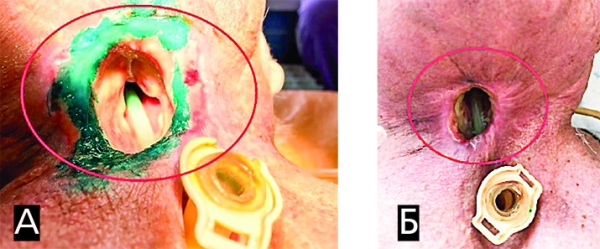 Онкологические заболевания гортани. Еще раз о важности регулярного наблюдения у профильных специалистов                     
        Онкологические заболевания гортани. Еще раз о важности регулярного наблюдения у профильных специалистов
