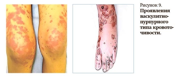 
        Геморрагический синдром: клиническая оценка и тесты                    