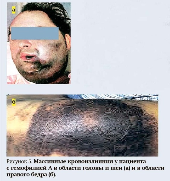 
        Геморрагический синдром: клиническая оценка и тесты                    