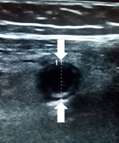 Алгоритм ультразвуковой диагностики острого аппендицита			     
        Алгоритм ультразвуковой диагностики острого аппендицита