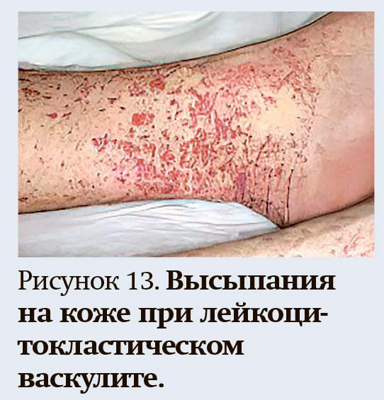 
        Геморрагический синдром: клиническая оценка и тесты                    