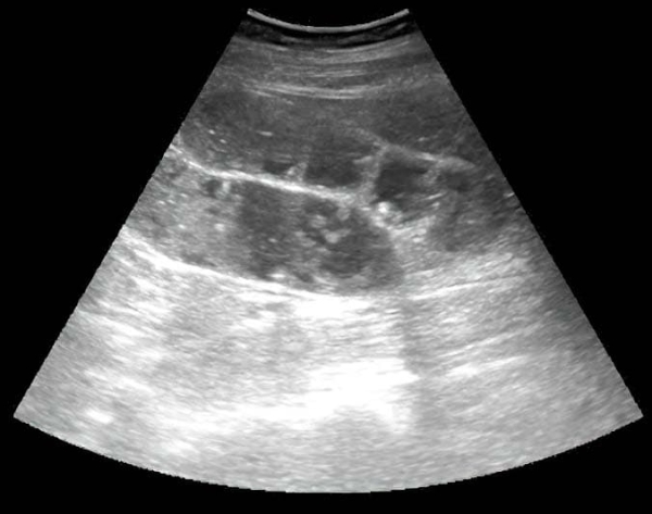 Алгоритм ультразвуковой диагностики острого аппендицита			     
        Алгоритм ультразвуковой диагностики острого аппендицита