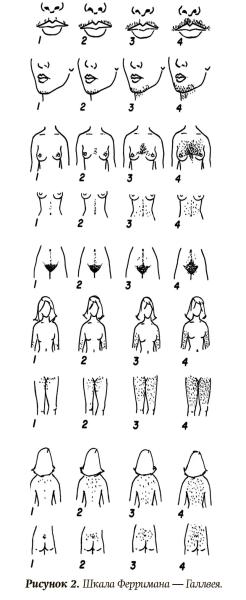 
        Проблемные вопросы диагностики гиперандрогении			    
