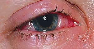 
        Возвращение туляремии…Что следующее?			    