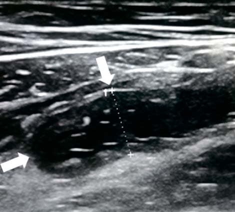 Алгоритм ультразвуковой диагностики острого аппендицита			     
        Алгоритм ультразвуковой диагностики острого аппендицита