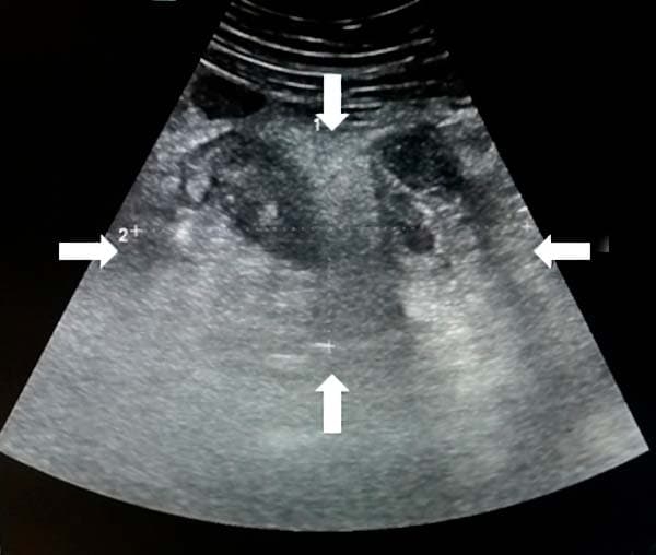 Алгоритм ультразвуковой диагностики острого аппендицита			     
        Алгоритм ультразвуковой диагностики острого аппендицита
